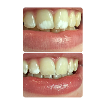 icon resin infiltration